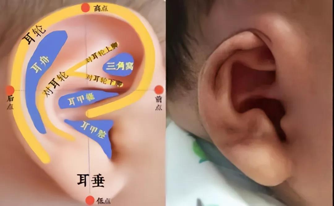 耳畸形2.jpg