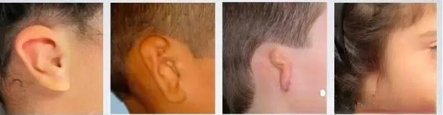 耳畸形9.jpg